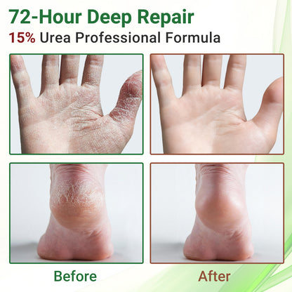 ishancare Cracked Skin Cream - Urea Intensive Repair & Moisturizing Treatment for Extremely Dry, Rough Hands and Cracked Heels - 200g Jar