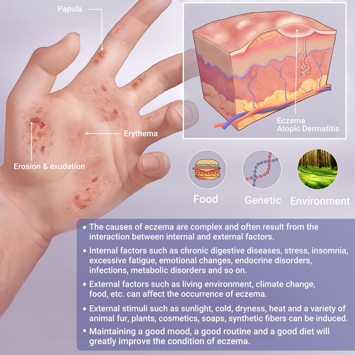 iShanCare® Eczema Cream, Maximum Strength Treatment Ointment for Psoriasis, Dermatitis, Rash, Infection, Jock Itch, Athletes Foot, Anti Itch, Relief for Redness, Irritated Skin, 1.77 Oz