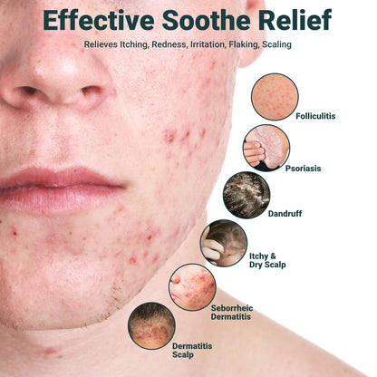 Creme Gegen Seborrhoische Dermatitis, Hochwirksame Behandlung Bei Psoriasis, Follikulitis, Dermatitis und Schuppen, Schnelle Linderung Bei Juckreiz, Rötungen, Reizungen und Schuppenbildung(3.53oz)
