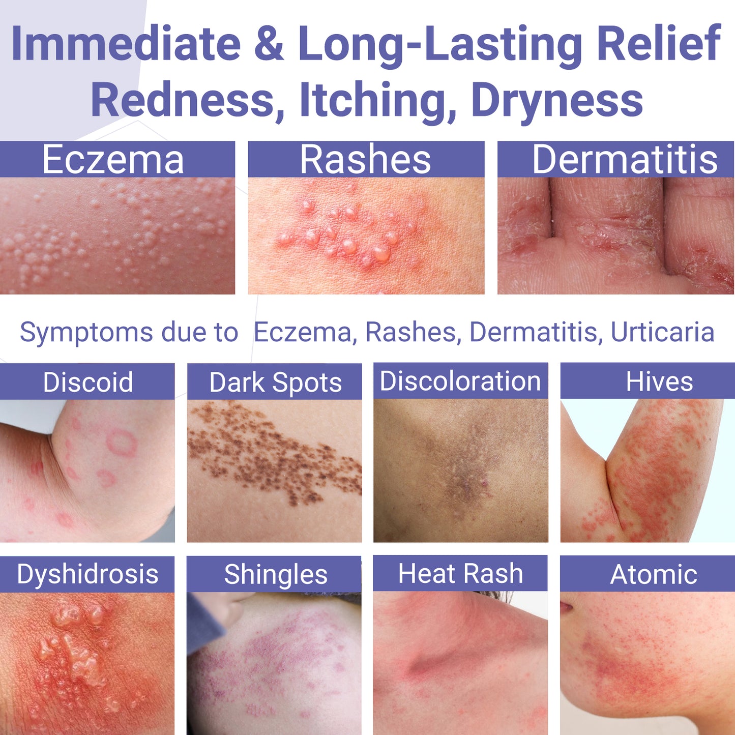 Eczema Cream, Eczema-Prone Skin Soothing & Moisturizing Treatment Ointment for Full Body Rash, Psoriasis, Dermatitis, Urticaria, Redness, Itching, Dryness, Crusting, Peeling, Acne, Pimples, Blisters