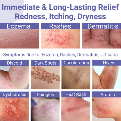 Eczema Cream, Eczema-Prone Skin Soothing & Moisturizing Treatment Ointment for Full Body Rash, Psoriasis, Dermatitis, Urticaria, Redness, Itching, Dryness, Crusting, Peeling, Acne, Pimples, Blisters