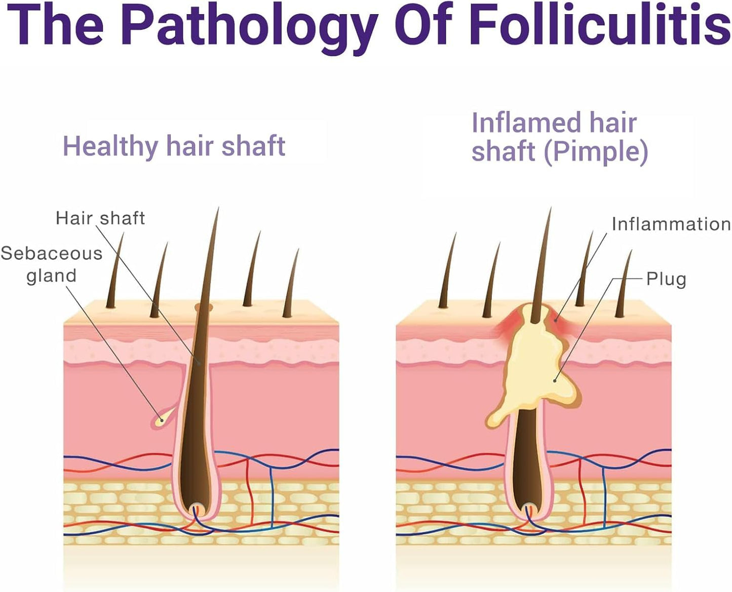 IShanCare Follikulitis-Behandlungscreme, natürlich, antibakteriell, gegen Juckreiz, Rötung, Entzündung, Schmerzen, Brennen, 100 g