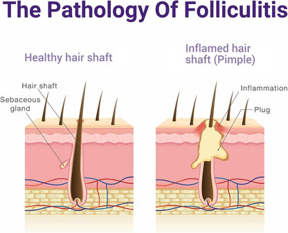 IShanCare Follikulitis-Behandlungscreme, natürlich, antibakteriell, gegen Juckreiz, Rötung, Entzündung, Schmerzen, Brennen, 100 g
