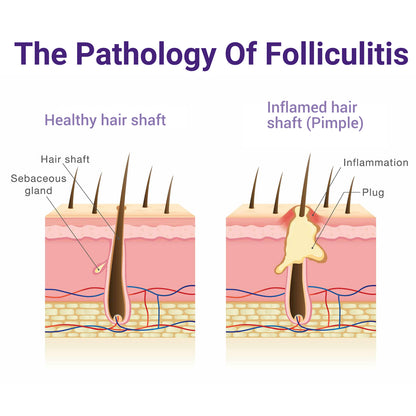ishancare Folliculitis Treatment, Highly Effective Folliculitis Cream, Natural folliculitis for Itching, Redness, Inflammation, Ache, Burning, 3.53 Oz