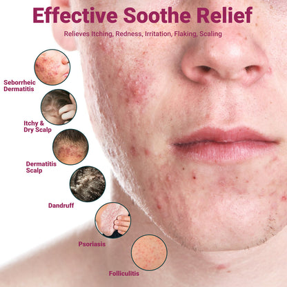 ishancare Seborrheic Dermatitis Cream, Maximum Strength Treatment for Psoriasis, Folliculitis, Dermatitis, Dandruff, Fast Relief for Itching, Redness, Irritation, Scaling, 3.53 Oz