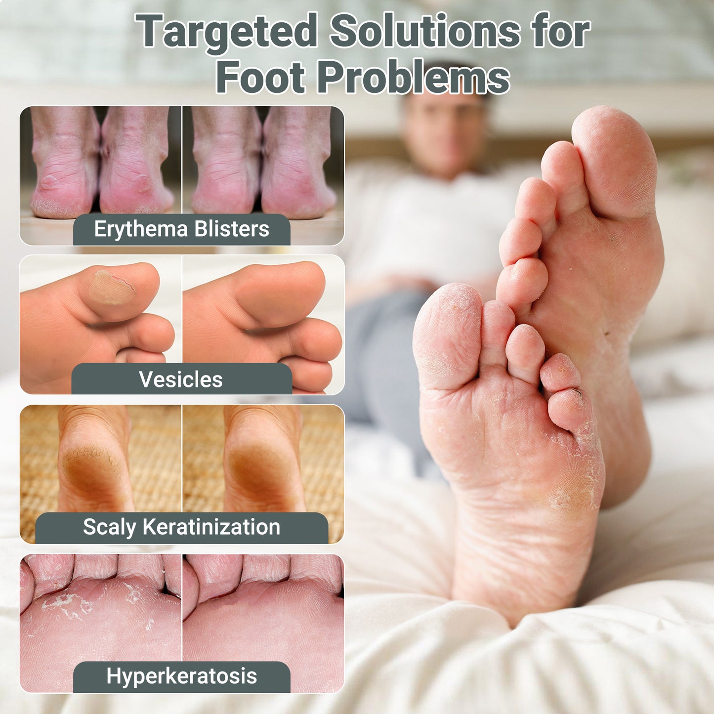 ishancare Extra Strength Antifungal Foot Cream (0.7oz) - Natural Herbal Treatment for Athlete's Foot - Relieves Itching, Burning, Cracking & Fungal Infections