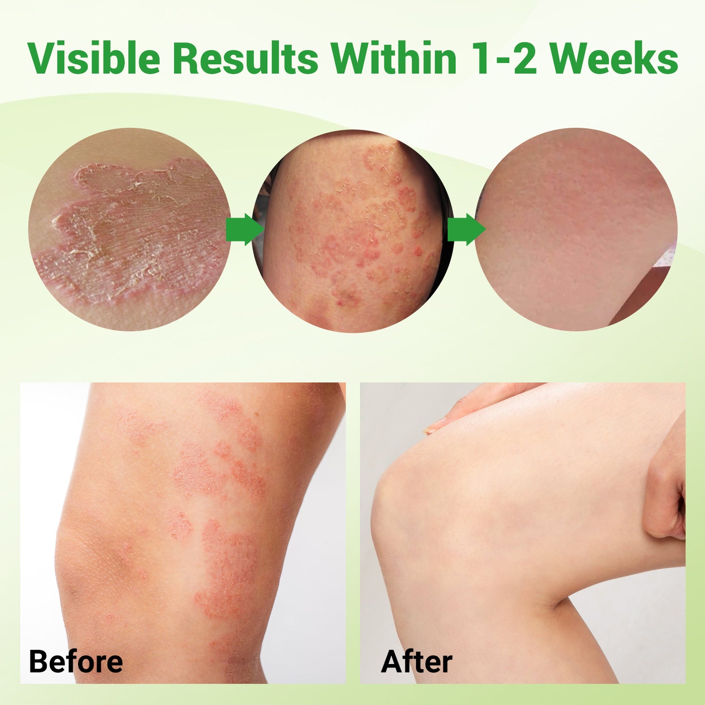 ishancare Jock Itch Cream, Extra Strength Jock Itch Treatment for Tinea Cruris, Tinea Corporis, Natural Relieves Itching, Burning, Chafing and Scaling, 3.53 OZ