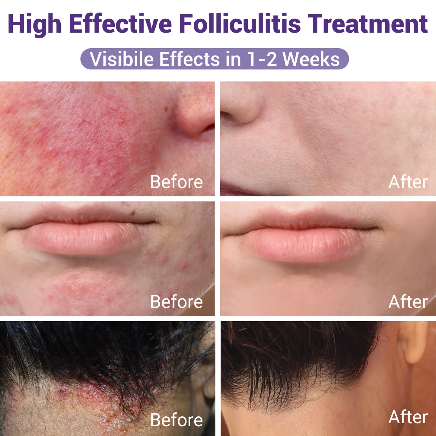 ishancare Folliculitis Treatment, Highly Effective Folliculitis Cream, Natural folliculitis for Itching, Redness, Inflammation, Ache, Burning, 3.53 Oz