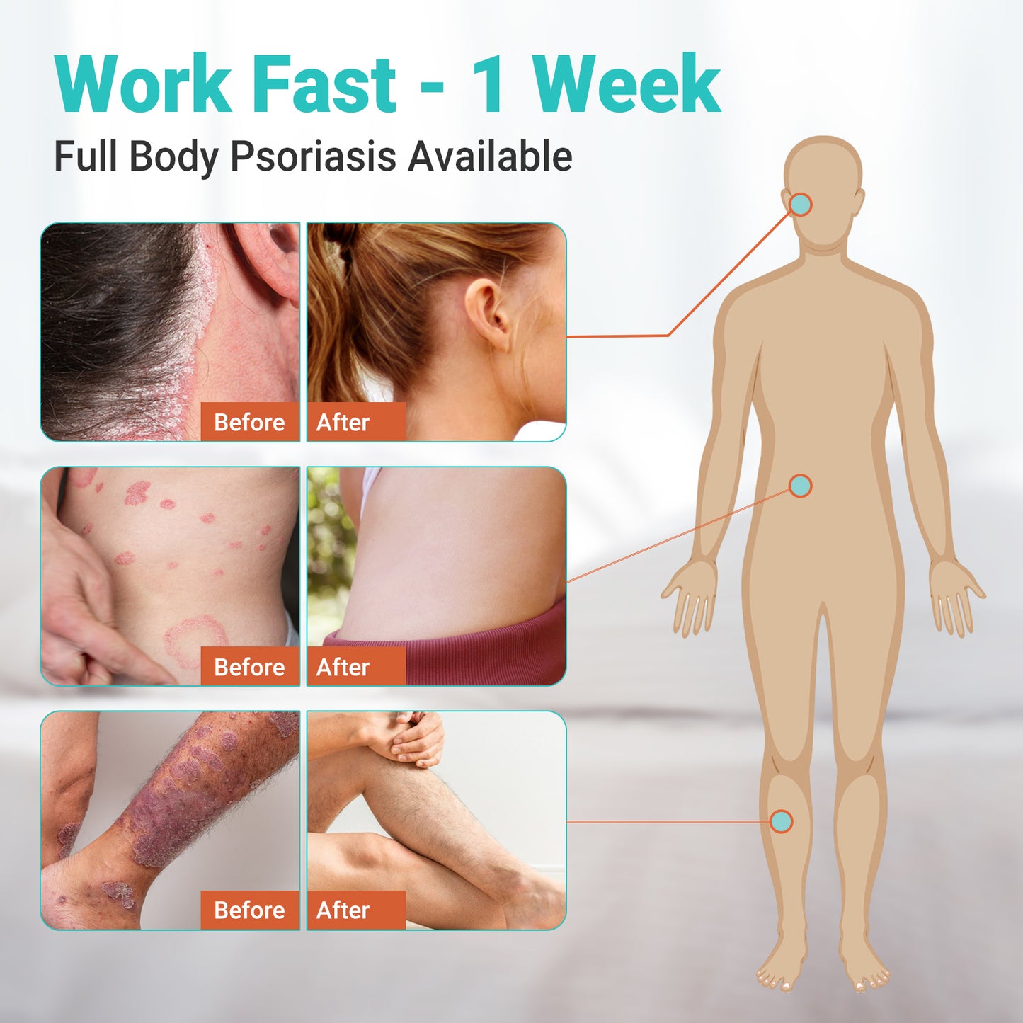 ishancare Psoriasis Cream, Potent Moisturizing Treatment Ointment for Psoriasis, Dermatitis & Rashes, Relief from Itching, Redness, Flaking & Scaling, Quick-Acting Soothing Cream for Dry Skin 3.53oz