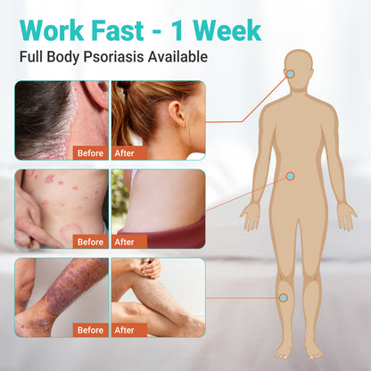 ishancare Psoriasis Cream, Potent Moisturizing Treatment Ointment for Psoriasis, Dermatitis & Rashes, Relief from Itching, Redness, Flaking & Scaling, Quick-Acting Soothing Cream for Dry Skin 3.53oz