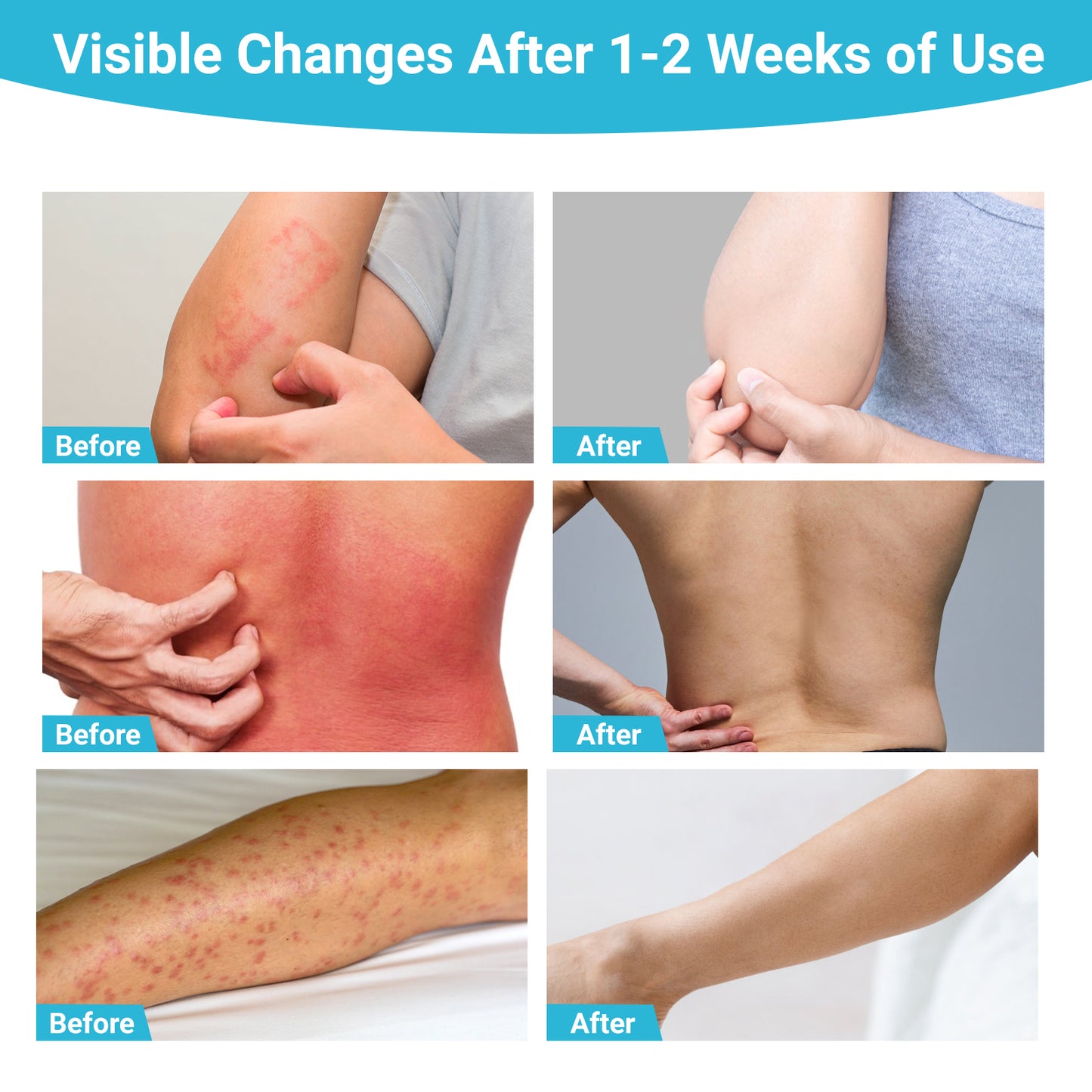 ishancare Antifungal Cream, All Natural Herbal Anti Fungal Skin Cream for Athlete's Foot, Jock Itch, Ringworm, Tinea Versicolor, Fungal Infection, 3.53 OZ