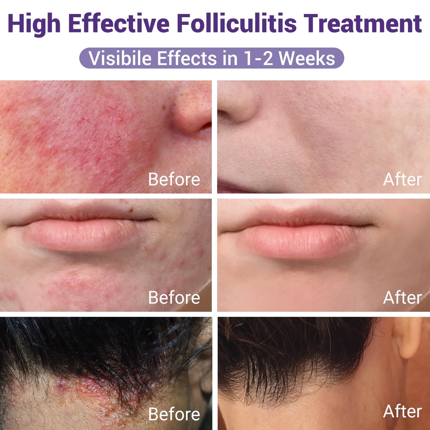 iShanCare Folliculitis Treatment, Highly Effective Folliculitis Cream, Natural Antibacterial Folliculitis for Itching, Redness, Inflammation, Pain, Burning, 353 Oz