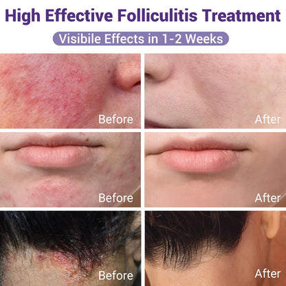 iShanCare Folliculitis Treatment, Highly Effective Folliculitis Cream, Natural Antibacterial Folliculitis for Itching, Redness, Inflammation, Pain, Burning, 353 Oz