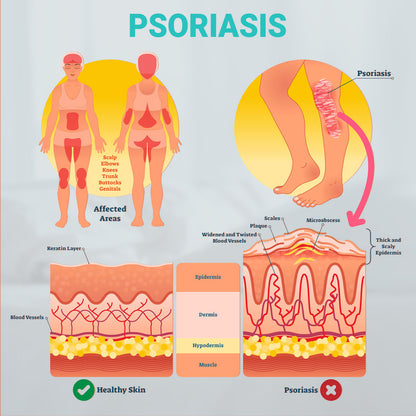 ishancare Psoriasis Cream, Potent Moisturizing Treatment Ointment for Psoriasis, Dermatitis & Rashes, Relief from Itching, Redness, Flaking & Scaling, Quick-Acting Soothing Cream for Dry Skin 3.53oz