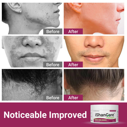 ishancare Seborrheic Dermatitis Cream, Maximum Strength Treatment for Psoriasis, Folliculitis, Dermatitis, Dandruff, Fast Relief for Itching, Redness, Irritation, Scaling, 3.53 Oz