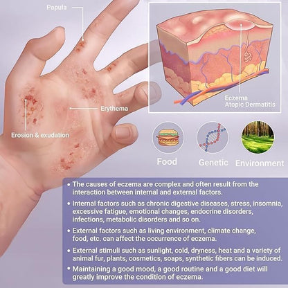 Ekzem-Creme, Ekzem-anfällige Haut beruhigende & feuchtigkeitsspendende Behandlung Salbe für den ganzen Körper Ausschlag, Psoriasis, Dermatitis, Urtikaria, Rötung, Juckreiz, Trockenheit, Krustenbildung