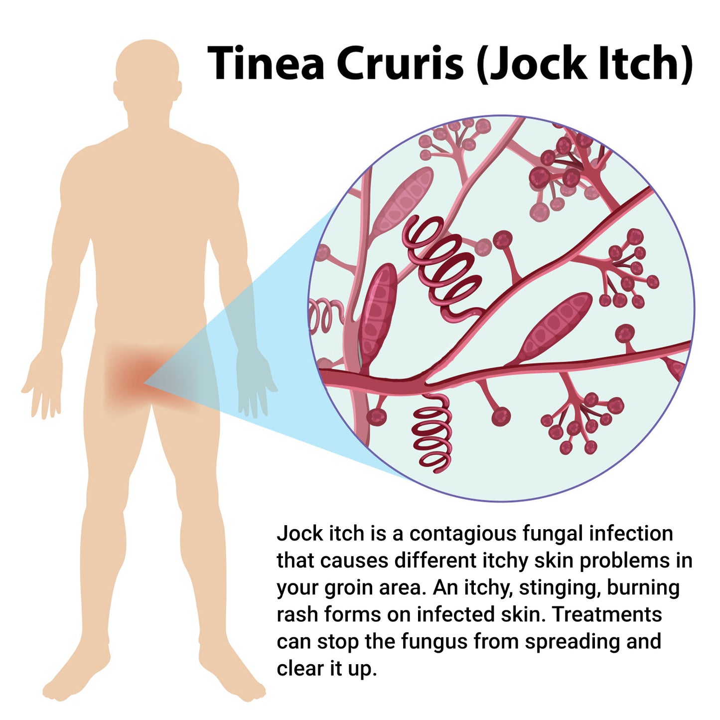 ishancare Jock Itch Cream, Extra Strength Jock Itch Treatment for Tinea Cruris, Tinea Corporis, Natural Relieves Itching, Burning, Chafing and Scaling, 3.53 OZ