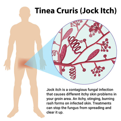ishancare Jock Itch Cream, Extra Strength Jock Itch Treatment for Tinea Cruris, Tinea Corporis, Natural Relieves Itching, Burning, Chafing and Scaling, 3.53 OZ