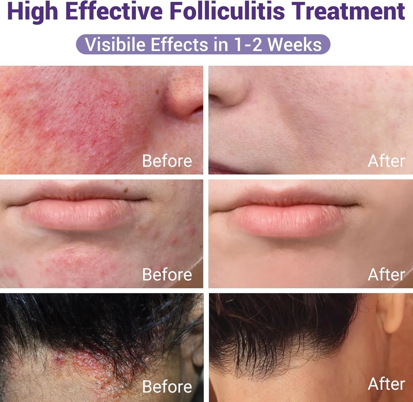 IShanCare Follikulitis-Behandlungscreme, natürlich, antibakteriell, gegen Juckreiz, Rötung, Entzündung, Schmerzen, Brennen, 100 g