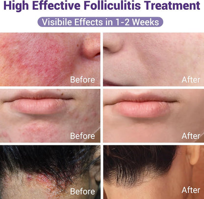 IShanCare Follikulitis-Behandlungscreme, natürlich, antibakteriell, gegen Juckreiz, Rötung, Entzündung, Schmerzen, Brennen, 100 g