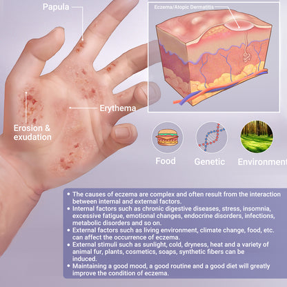 Eczema Cream, Eczema-Prone Skin Soothing & Moisturizing Treatment Ointment for Full Body Rash, Psoriasis, Dermatitis, Urticaria, Redness, Itching, Dryness, Crusting, Peeling, Acne, Pimples, Blisters