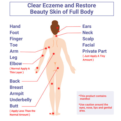 iShanCare® Eczema Cream, Maximum Strength Treatment Ointment for Psoriasis, Dermatitis, Rash, Infection, Jock Itch, Athletes Foot, Anti Itch, Relief for Redness, Irritated Skin, 1.77 Oz