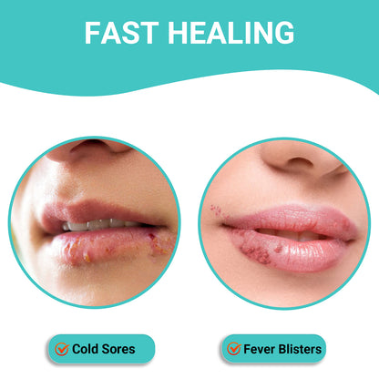 Creme zur Behandlung von Lippenherpes, schnelle Linderung, beruhigende Feuchtigkeit, handliche und hypoallergene Formel für gesunde Lippen, 10g
