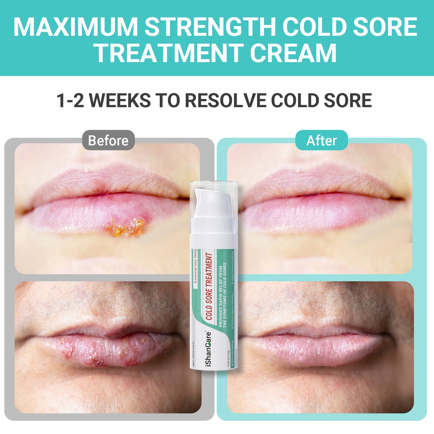 Creme zur Behandlung von Lippenherpes, schnelle Linderung, beruhigende Feuchtigkeit, handliche und hypoallergene Formel für gesunde Lippen, 10g
