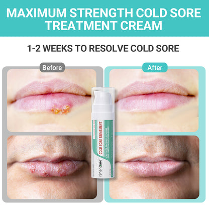 Creme zur Behandlung von Lippenherpes, schnelle Linderung, beruhigende Feuchtigkeit, handliche und hypoallergene Formel für gesunde Lippen, 10g