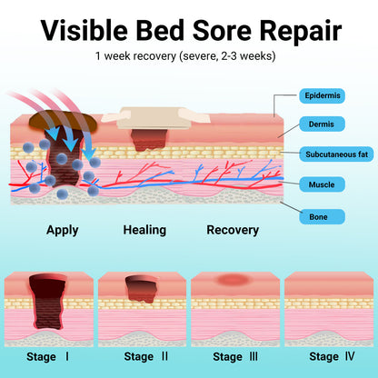 ishancare® Bed Sore Cream - Fast & Safe Natural Healing Pressure Sore Cream, Bedsore Wound Care Healing Ointment, Treatment for Bed sores Pressure Sores Diabetic Ulcer Wounds Burns and Cuts