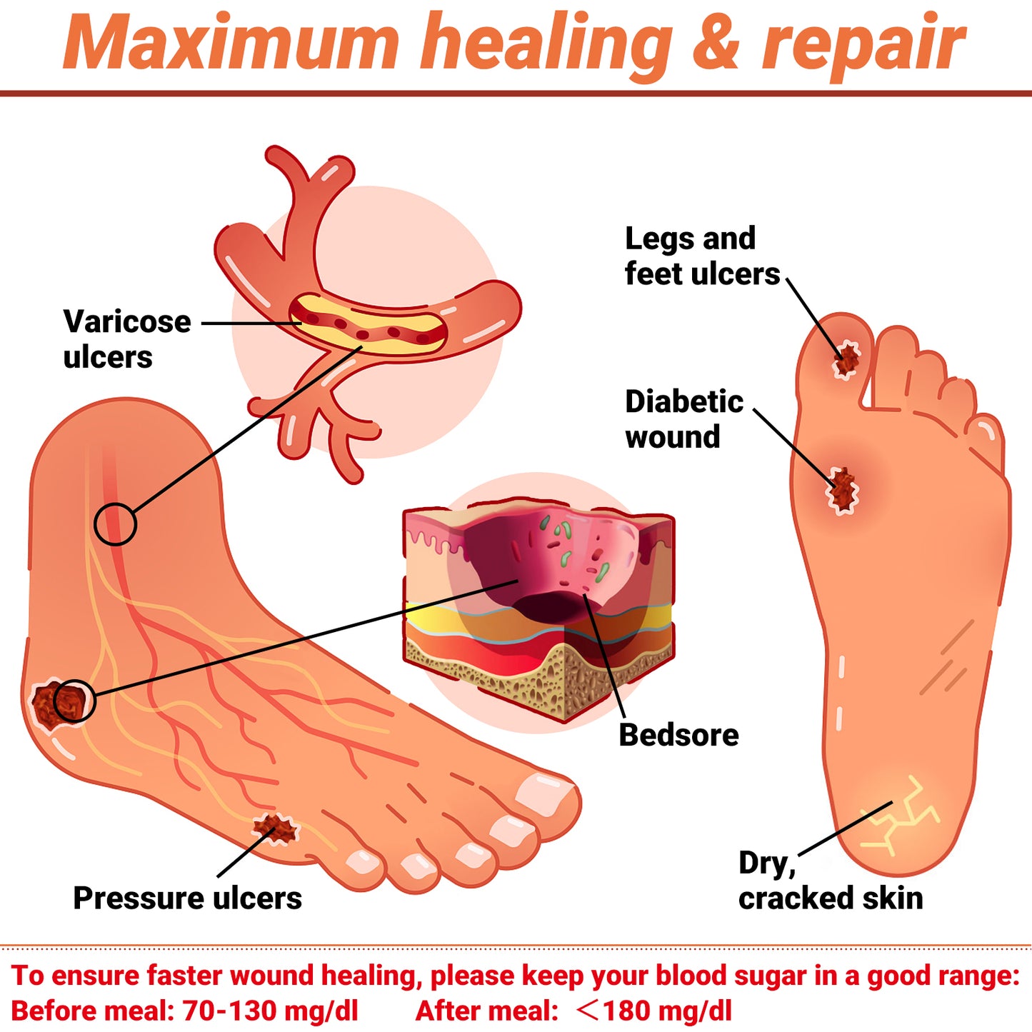 iShanCare® Diabetic Wound Ulcer Cream - First Aid Healing Ointment, Natural Protective Ointment for Leg & Foot Ulcers, Venous Ulcers, Bed Sores, Pressure Sores and Septic Wounds