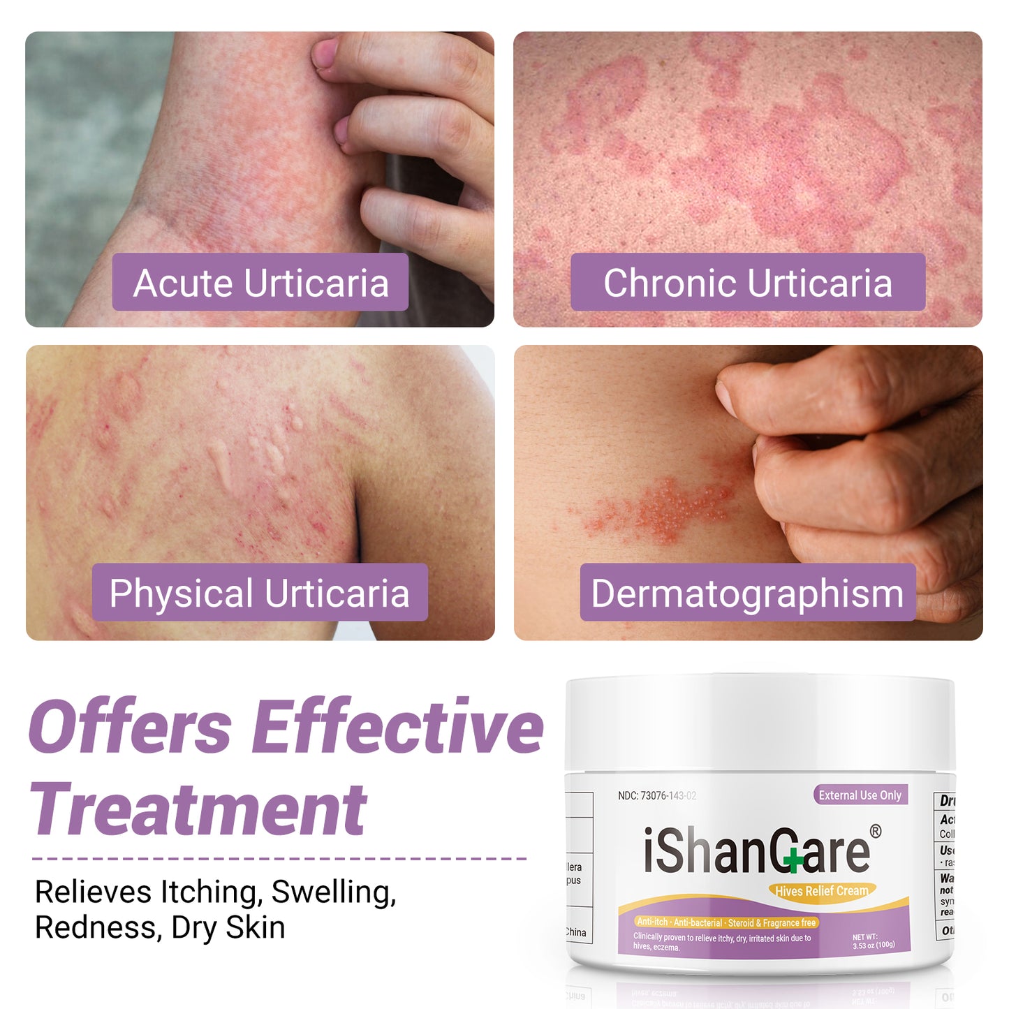 ishancare Urticaria Cream, Fast Acting Relief of Hives, Allergic Rashes, Itchy Skin, Redness, Swelling, Anti Fungal Hives Cream with All Natural Herbal Ingredients, 3.53 Oz