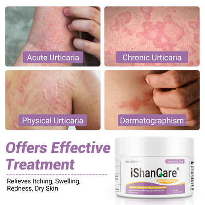 ishancare Urticaria Cream, Fast Acting Relief of Hives, Allergic Rashes, Itchy Skin, Redness, Swelling, Anti Fungal Hives Cream with All Natural Herbal Ingredients, 3.53 Oz