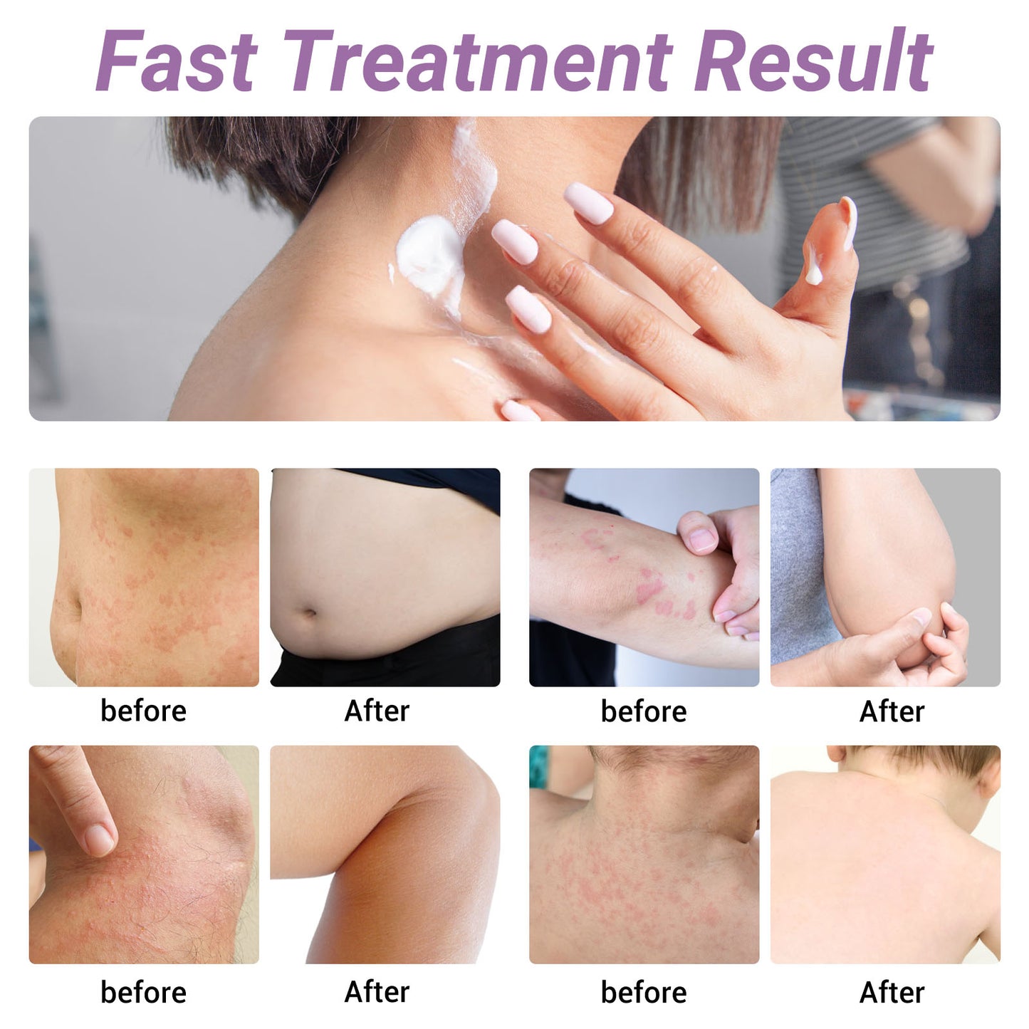 ishancare Urticaria Cream, Fast Acting Relief of Hives, Allergic Rashes, Itchy Skin, Redness, Swelling, Anti Fungal Hives Cream with All Natural Herbal Ingredients, 3.53 Oz